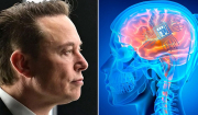 Η εταιρεία «Neuralink» του Έλον Μασκ έλαβε άδεια να δοκιμάσει εμφύτευμα εγκεφάλου σε ανθρώπους