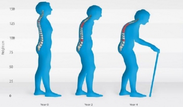 Χιλιάδες ηλικιωμένους σκοτώνει κάθε χρόνο η οστεοπόρωση