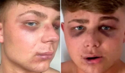 Ζάκυνθος: «Με έστειλαν στο νοσοκομείο για μία selfie», λέει ο Βρετανός τουρίστας που ξυλοκοπήθηκε από μπράβους