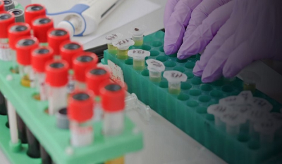 Αναπτύχθηκε το πρώτο «έξυπνο» τεστ αίματος που ανιχνεύει πάνω από 50 είδη καρκίνου