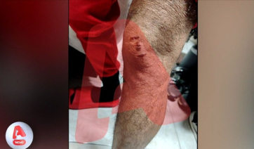 Ληστεία με πίτμπουλ - Γροθιές και δαγκωνιές στην Ομόνοια (βίντεο)